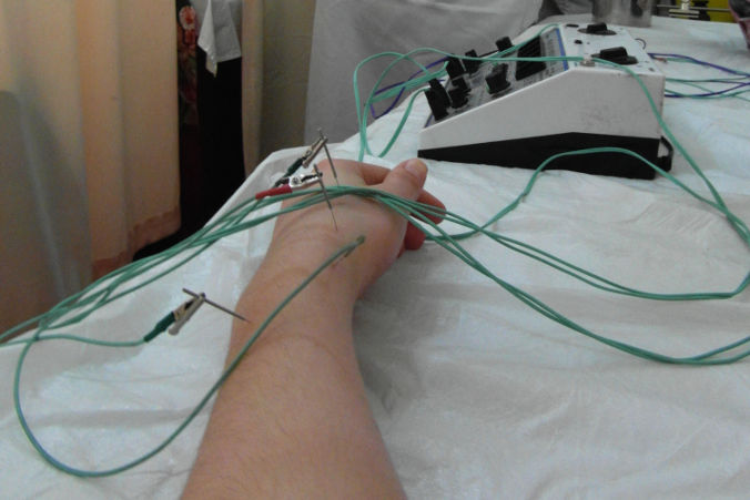acupuntura eléctrica china