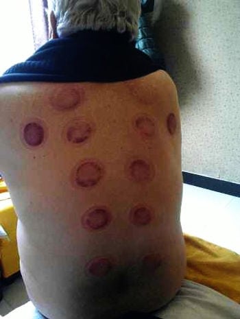 segni freschi delle ventose ventosefresche